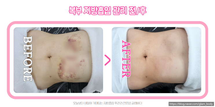  복부 지방흡입 리터치 관리는 어떻게 하나요?