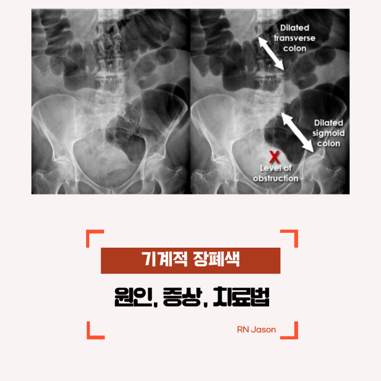  기계적 장폐색(Mechanical Obstruction)의 원인과 증상 및 치료에 대해서 알아봐요~