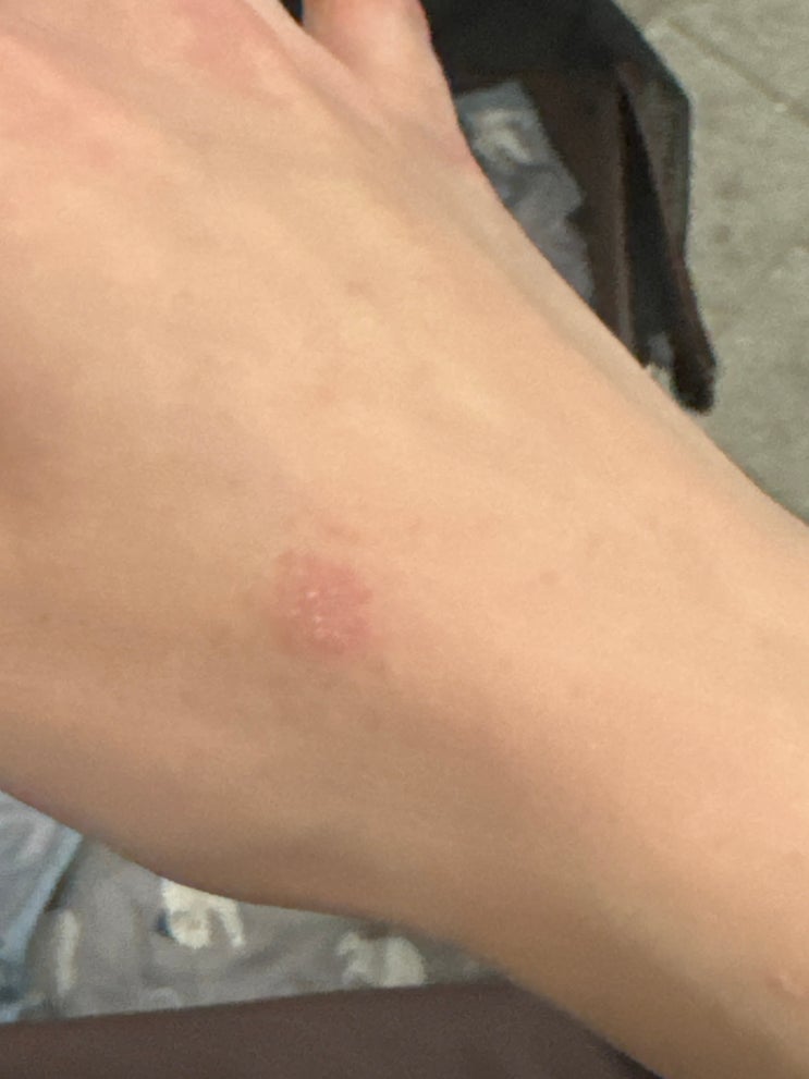  한포진 초기 / 한포진에 좋은 음식, 안 좋은 음식