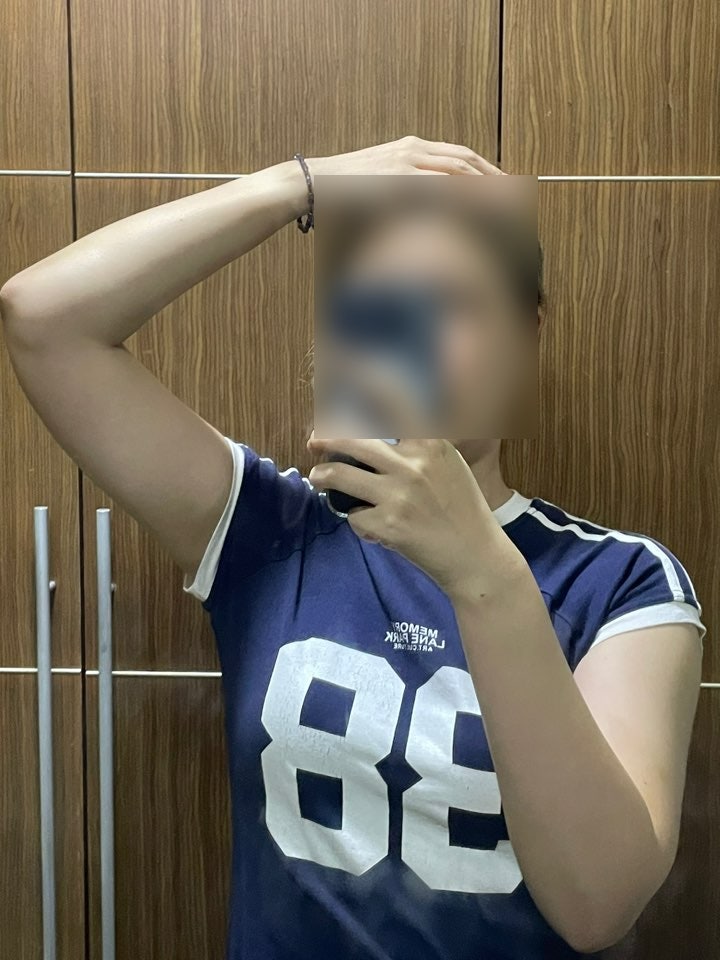  [서울/신촌] 팔뚝지방추출주사 후관리 종류와 한달 후기