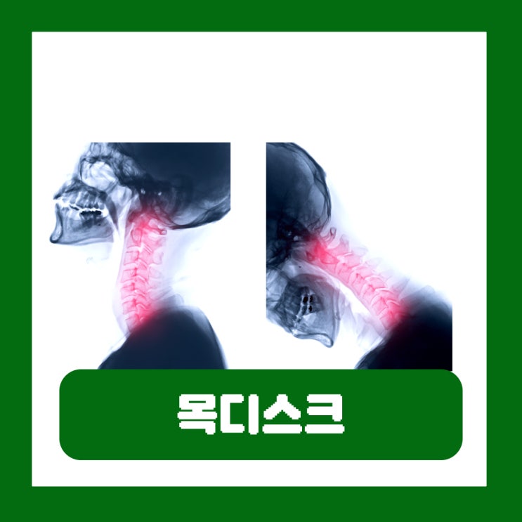  목디스크초기증상 원인 등통증 전문병원 MRI 검사 주사 치료
