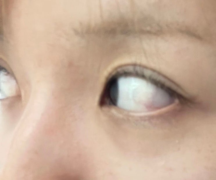  알레르기성 결막염 3개월 치료 후기 (라섹 후 부작용 관리!)