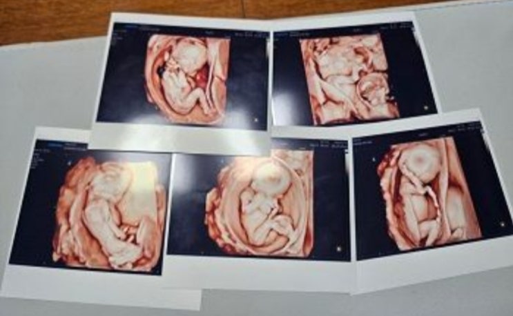<실시간 핫이슈> 자연임신 다섯쌍둥이 탄생 '경사'..."국내 처음, 세계적 드물어" <실시간 핫이슈> 자연임신 다섯쌍둥이 탄생 '경사'..."국내 처음, 세계적 드물어"