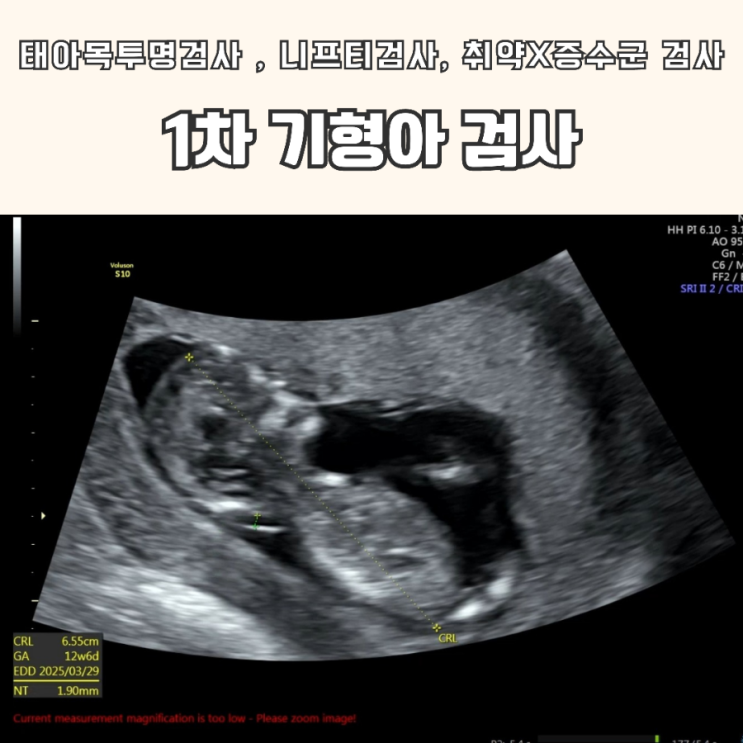  1차 기형아 검사 (태아목투명검사,니프티검사, 취약X증후군검사)_ 35세 이상 의료비지원으로 할인받기