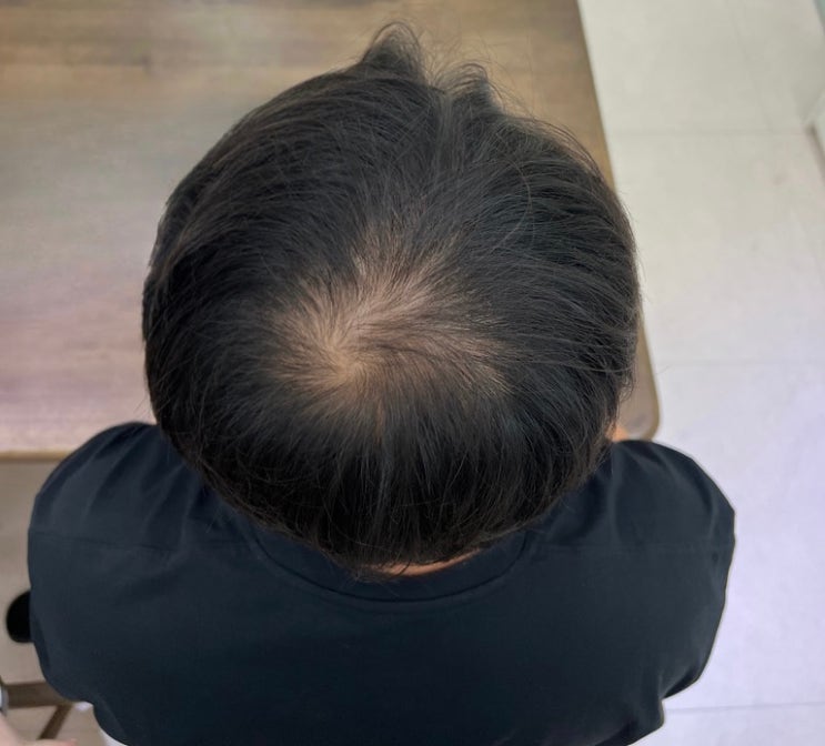  광주 정수리 탈모 원인과 해결방법 3가지