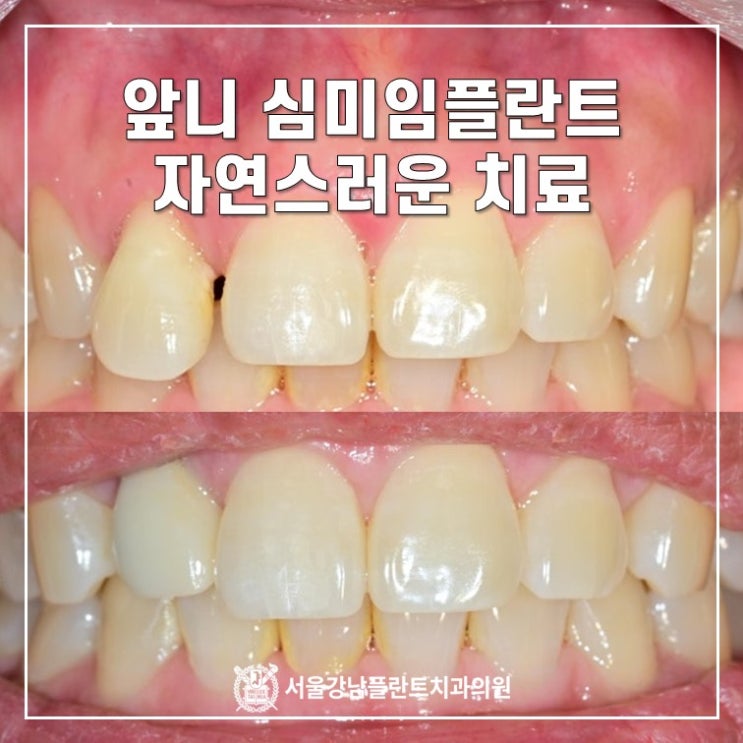  앞니 (전치부) 심미임플란트 - 자연치아보다 더 자연스럽게