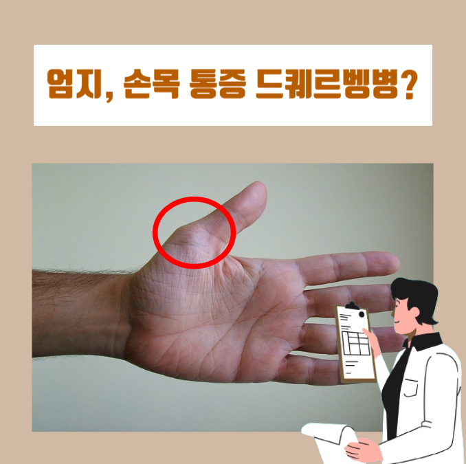  엄지손가락 통증이 욱신거려요, 드퀘르벵병 확인방법