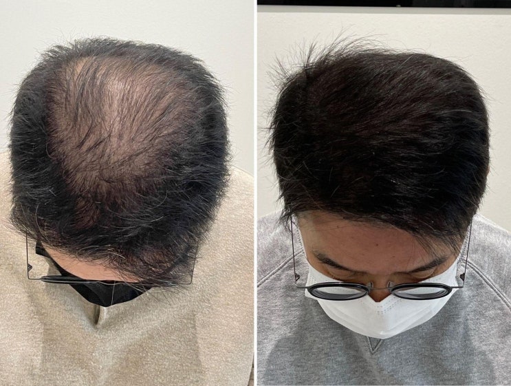  검단 마전동 원당동 두피문신의 새로운 기준! 진정성 넘치는 두피문신 전문점 필릭스스칼프를 소개합니다.
