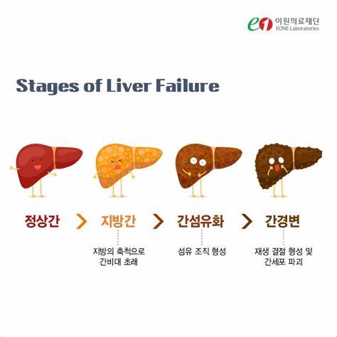 간건강정보 간섬유종이란