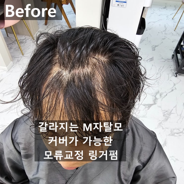  M자탈모 커버가 가능한 모류교정 탈모커버 링거펌으로 채우다