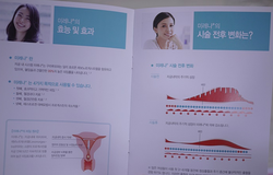 미레나 시술 1년 후기: 자궁 내막증 예방의 중요성
