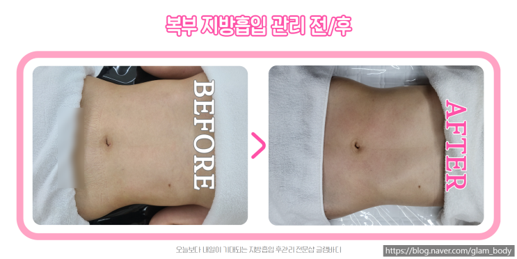  상체 지방흡입 사후관리로 자신감 찾기! 5회차(전/후)
