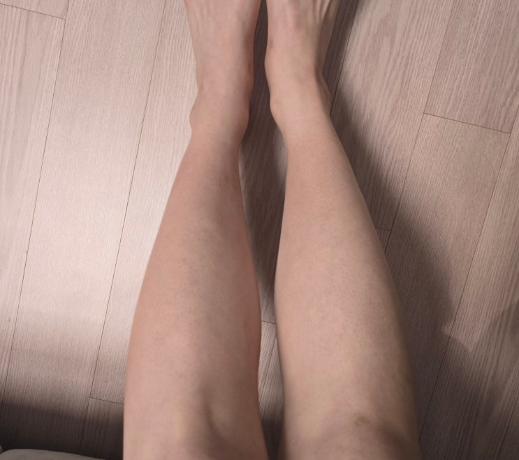  압구정로데오제모 젠틀맥스프로플러스 다리레이저제모 3회차 후기