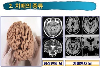 노인성질환 치매