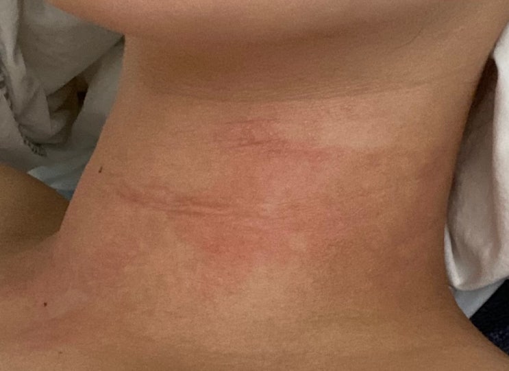  접촉성피부염 목 가려움 두드러기 관리 방법 빨리 낫는법