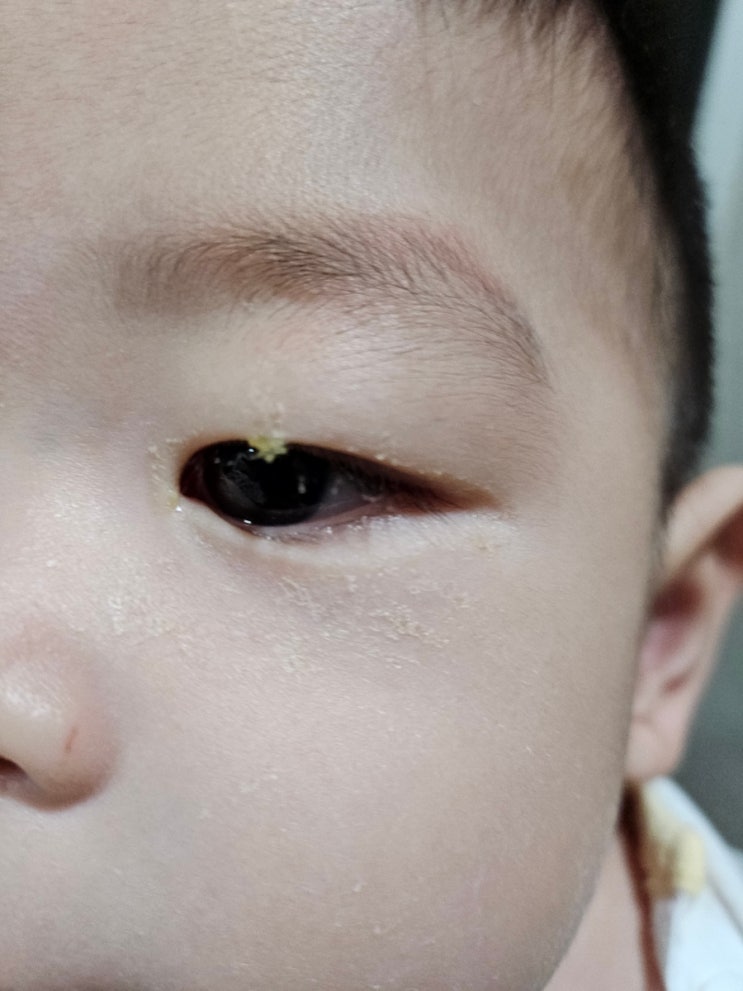  아기 눈꼽감기 원인 아기 눈 충혈됐을 때 안약