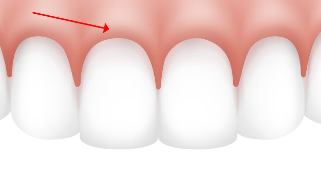  잇몸이 더 잘 내려가는 사람이 있다 - 치은 유형 (Gingival Biotype)