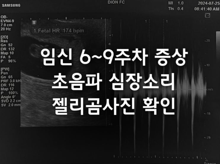  임신 6주차 7주 8주 9주 증상 갈색혈 초음파 심장소리 젤리곰 사진
