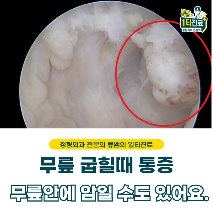  무릎 안에 혹 관절경 수술로 제거하기  (의사작성)