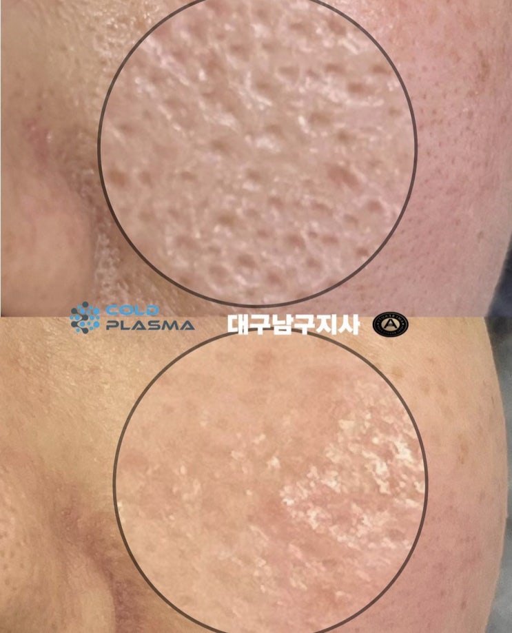  대구 아미뷰티, 플라즈마 피부관리로 모공, 여드름흉터를 효과적으로 개선하세요