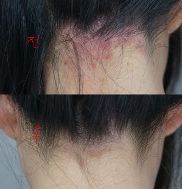 지루성두피염 헤드엔숄더 클리니컬 스트렝스 오일컨트롤 효과 2배보는법