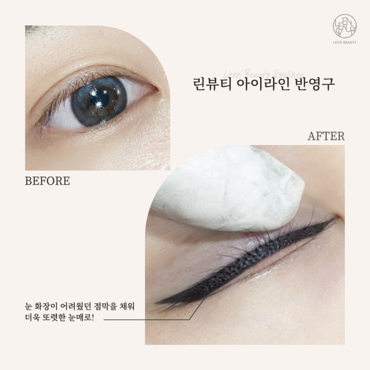  [무제한 레이저] 아이라인 잔흔제거 잘하는곳 비용 이벤트