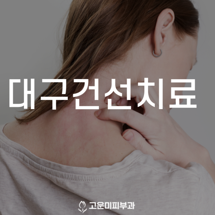  대구건선치료 찬바람이 불기 시작하면 피부에 각질이 생기는 건선 맞춤 치료