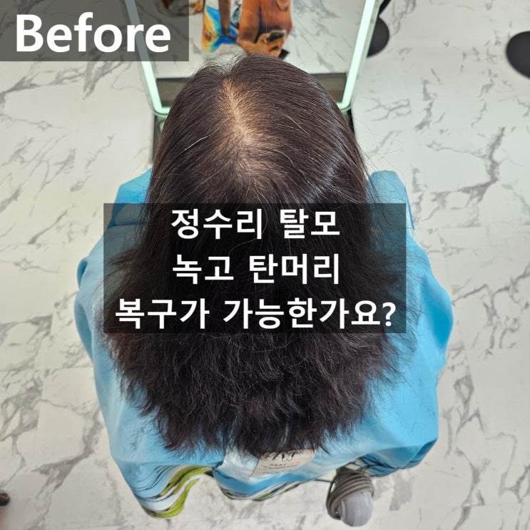  의정부모류교정 매직셋팅과 탈모커버를 한번에