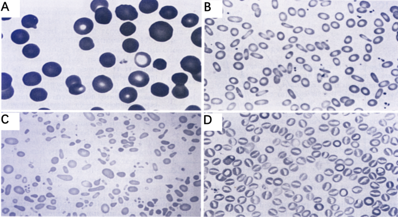 용혈성 빈혈 Hemolytic Anemia - 내인성, 외인성 분류