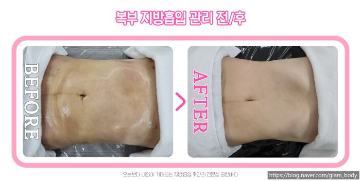  복부 지방흡입 후관리 : 고주파로 더 빠른 회복효과