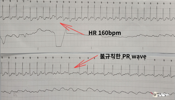 A-fib RVR EKG 모양 및 특징 그리고 PSVT와 A-fib RVR 차이점 : 네이버 블로그