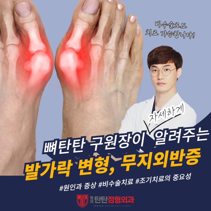  대구무지외반증 엄지발가락 휨 저림 증상 비수술로 치료 가능합니다.<정형외과 전문의 작성>