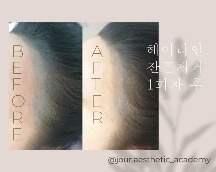  ◽부산 범일동 곰팡이? 망한 헤어라인 제거◽주르 에스테틱