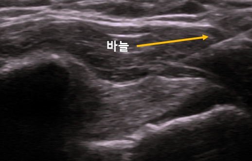  주월동 정형외과, 오십견 자연치유가 힘든 이유