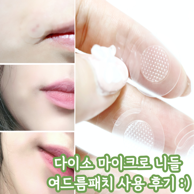  다이소 마이크로 니들 여드름 패치, 빠른 트러블 케어 가능