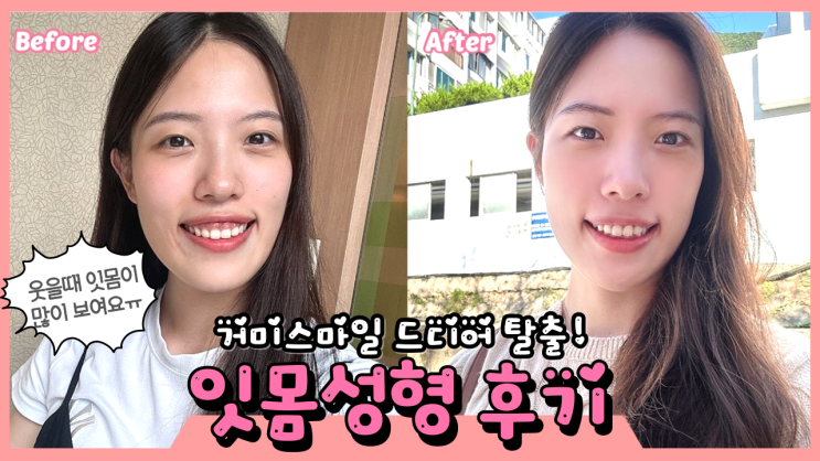  잇몸성형 부작용, 효과, 주의사항