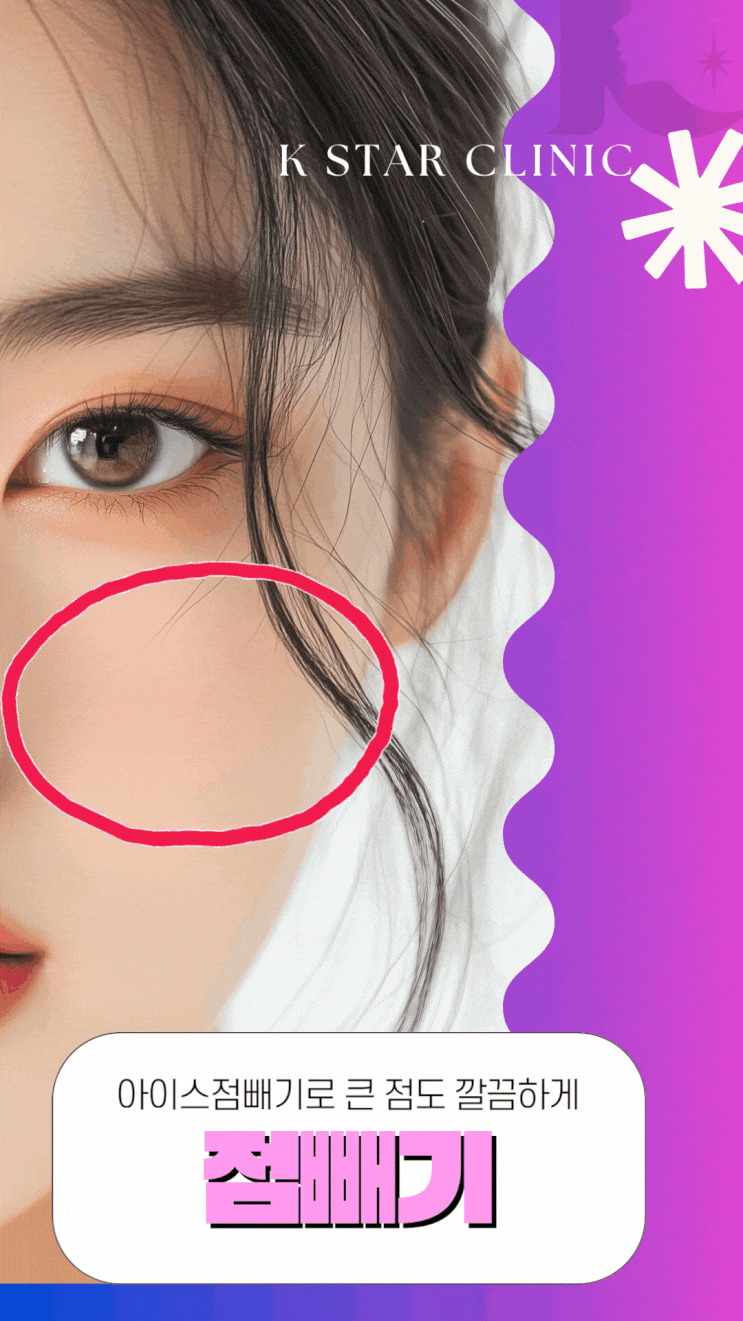  수완지구점빼기 광주 아이스점빼기로 큰점도 깨끗하게 제거