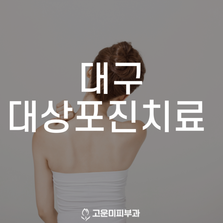  대구대상포진치료 피부에 발진을 일으키고 심한 통증을 유발하는 대상포진