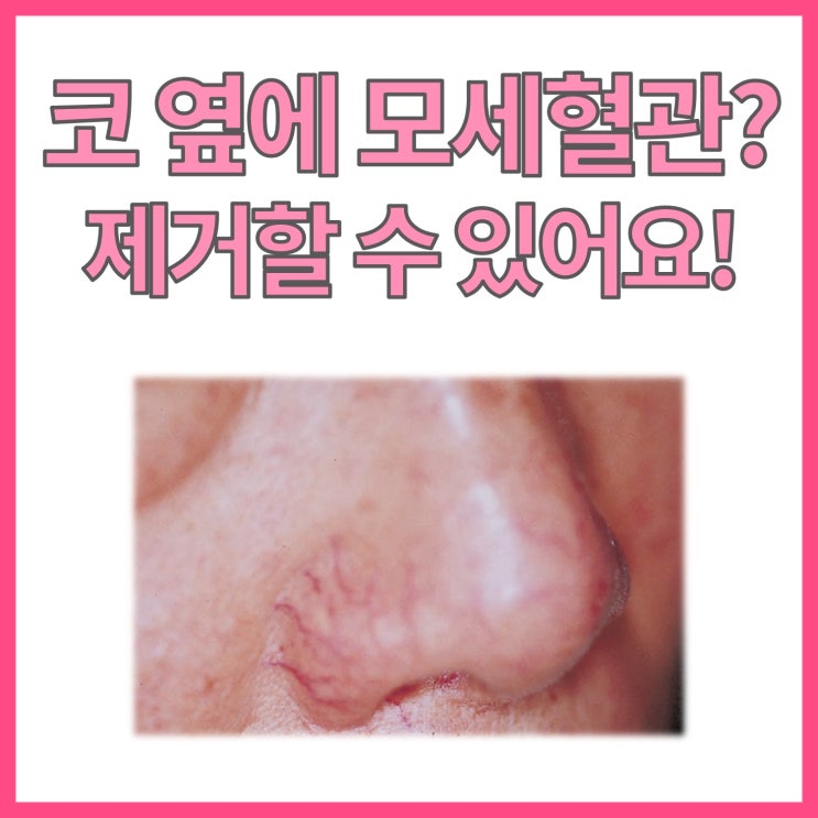  어느 날 코 옆에 붉은 혈관이? 모세혈관확장증(Telangiectasia)에 관하여