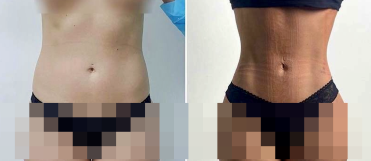  갈비뼈를 제거하지 않는 절골 재배치 허리 흉통 축소 수술