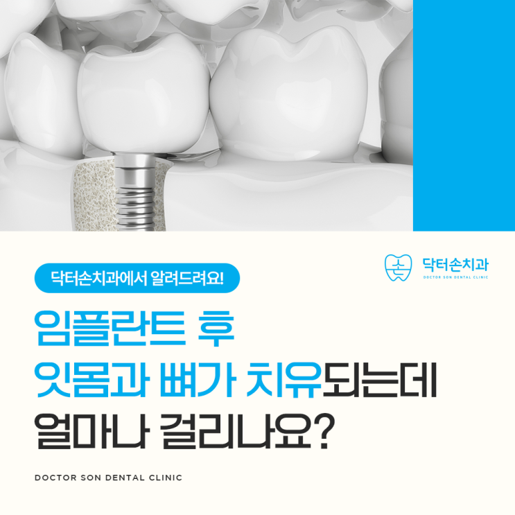  임플란트 시술 후 잇몸과 뼈가 완전히 치유되기까지는 얼마나 시간이 걸리나요?