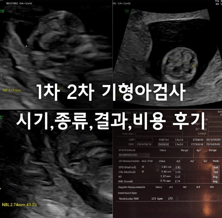  1차 2차 기형아검사 시기 종류 결과 비용 동탄제일병원 산부인과 후기
