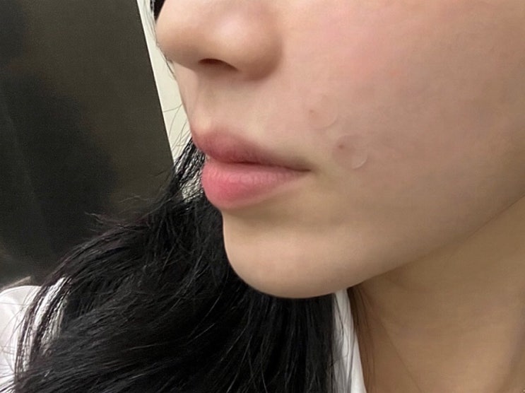  팔자주름 귀족침 맞고 온 솔직 후기