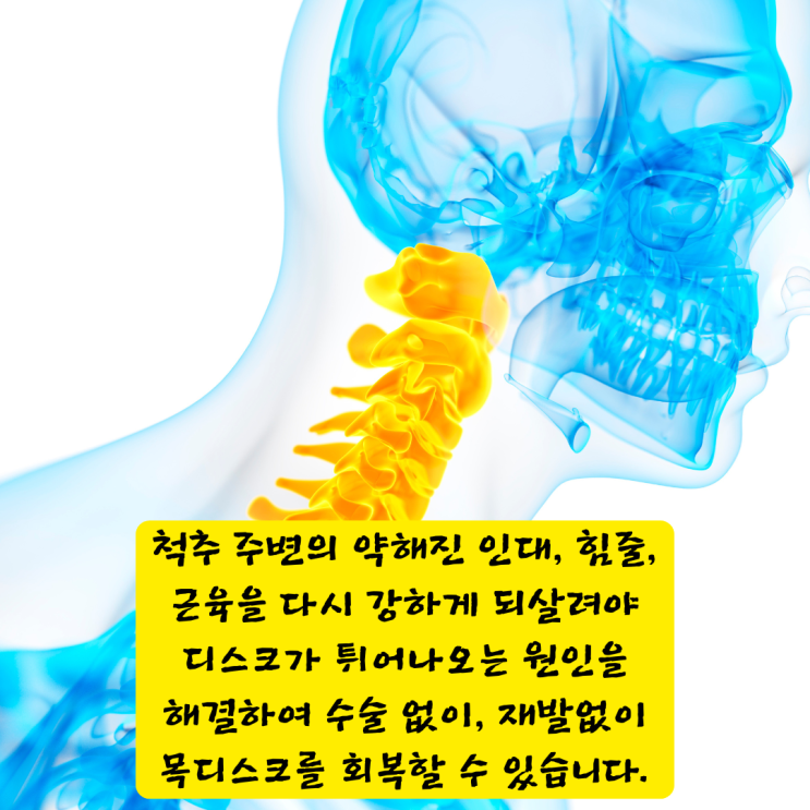  부산신경외과, 목디스크 수술 없이 회복할 수 있는 비밀