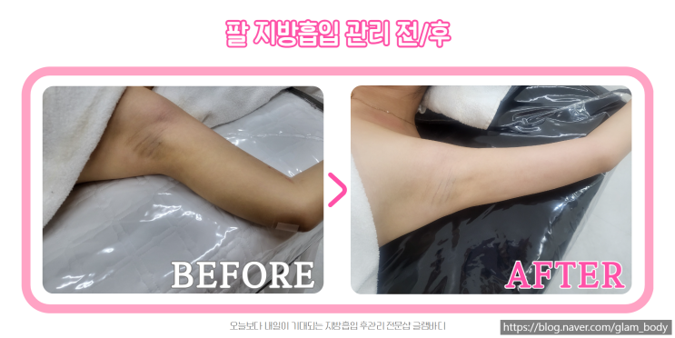  팔 지방흡입 사후관리 2주차 후기!