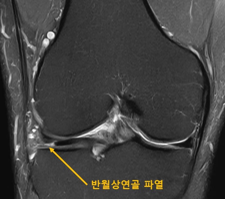  광주 무릎 병원, 반월상연골 파열수술 필요할까요?