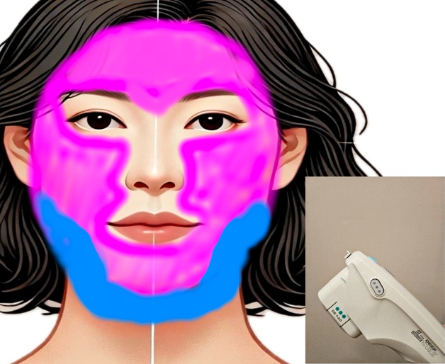  [울써마지 효과] 울쎄라 + 써마지리프팅의 상호보완 - 삼성동피부과전문의 닥터림