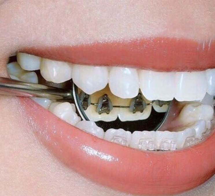 설측 교정의 장단점 - 설측교정을 받는 환자의 입장에서 (치과의사의 설명)