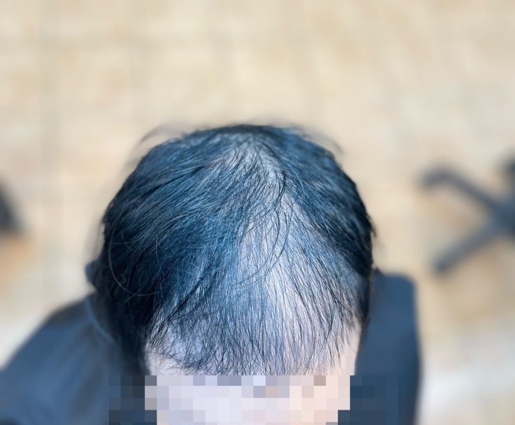  여자 심한전체탈모 히든탈모커버성형펌 계산전계산후 부산사상 르네시떼6층 미용실