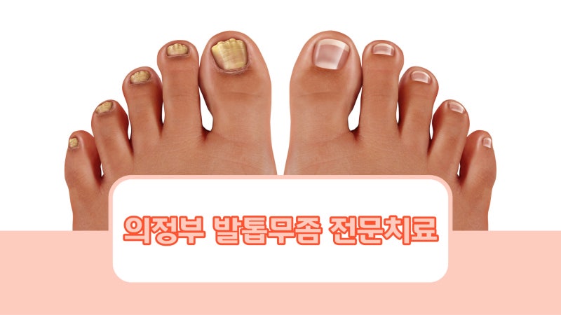 의정부 내성발톱 샵과 병원치료의 차이점!